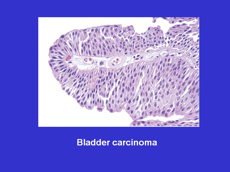 Bladder carcinoma
